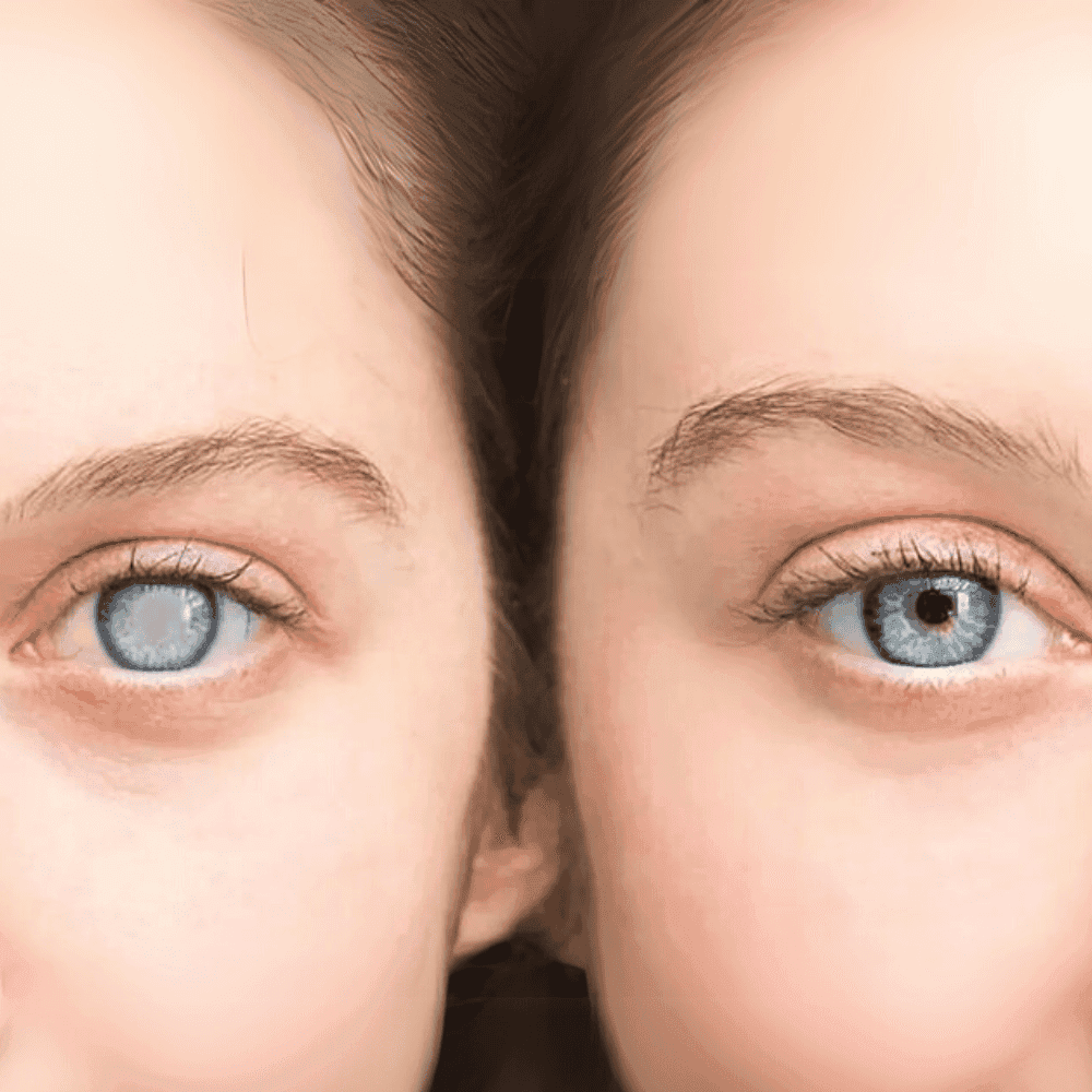 Nhận diện biến chứng mắt ở người đái tháo đường