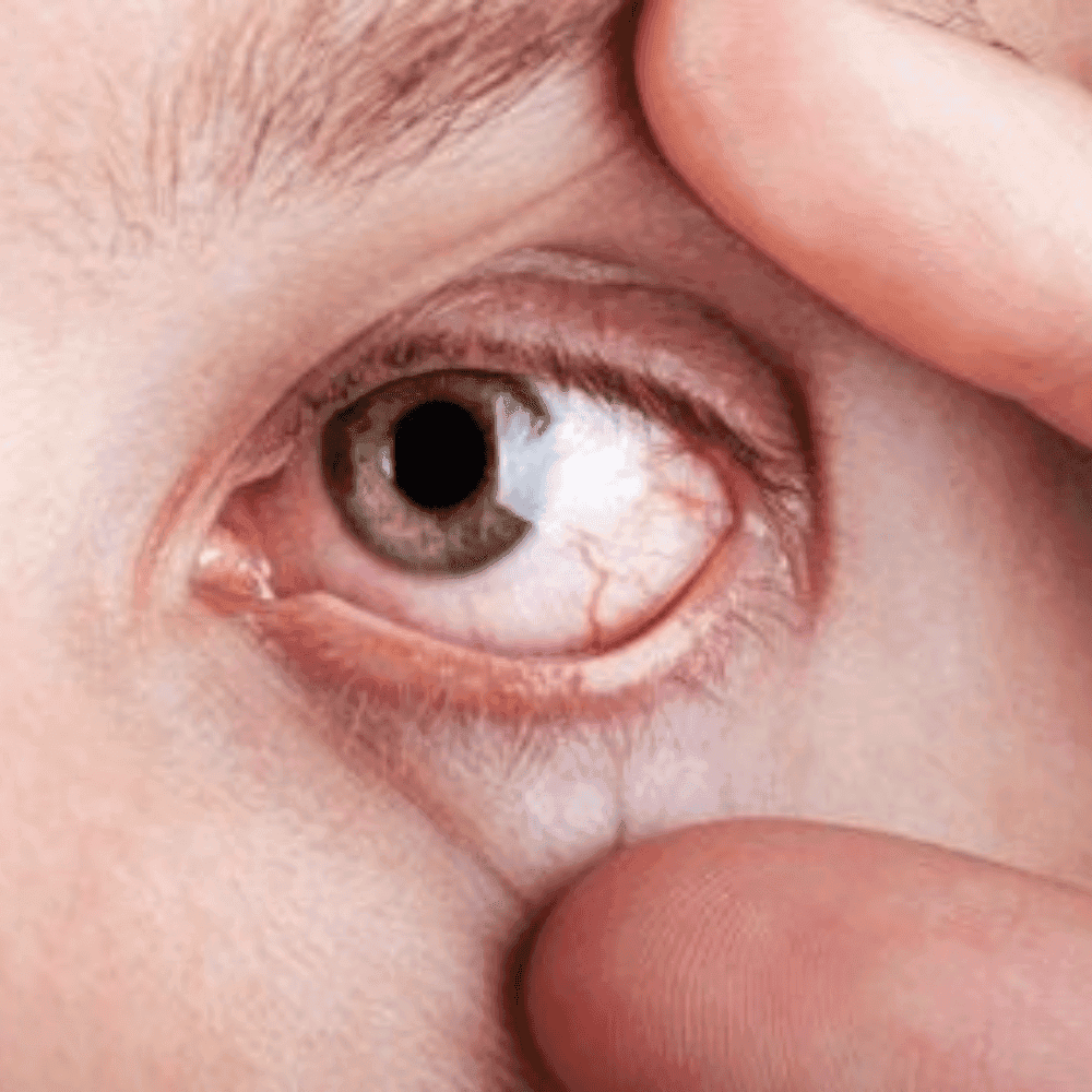 Không thể bỏ qua 4 dấu hiệu võng mạc đái tháo đường này