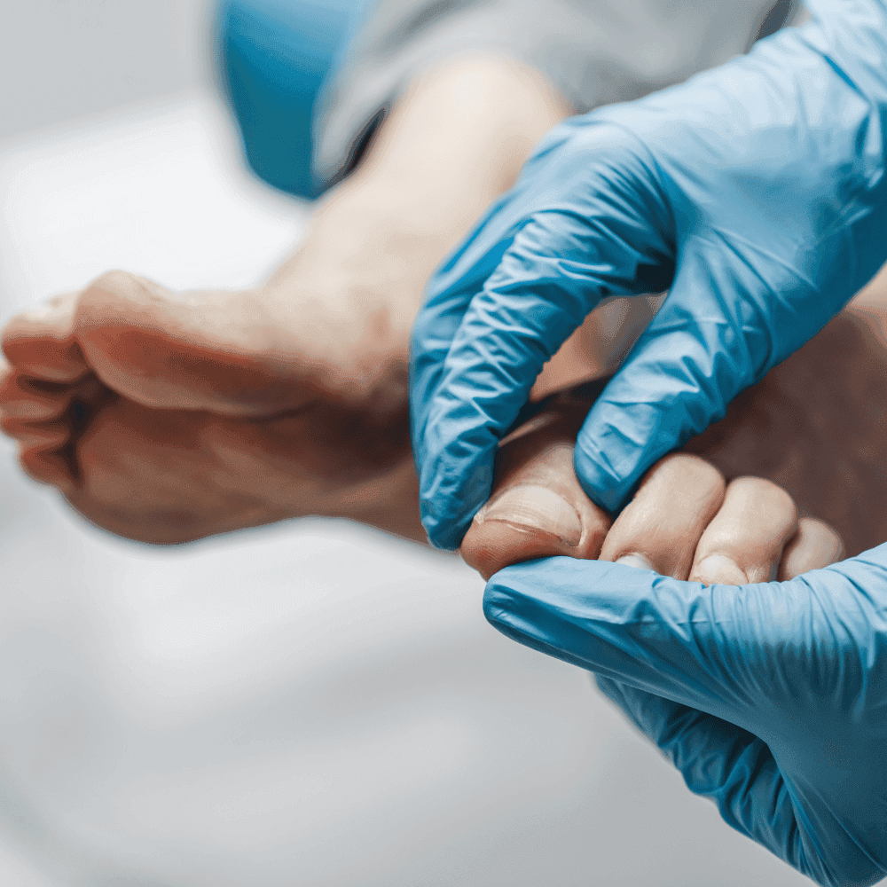 Biến chứng tổn thương bàn chân ở người đái tháo đường